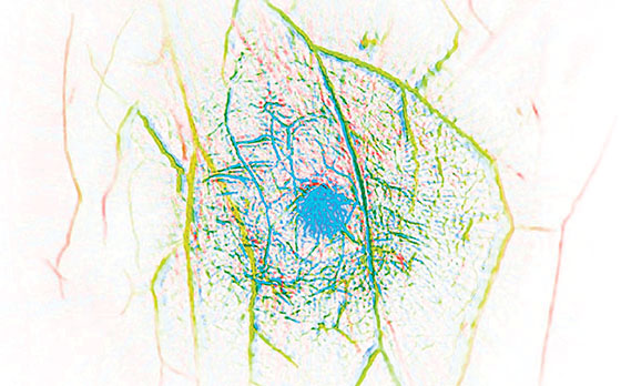 Photoacoustic computed tomography of a healthy human breast acquired in vivo within a single-breath hold without using any harmful ionizing radiation or contrast agent. This new technology can image blood vessels as small as a few times the diameter of a human hair, outperforming all other imaging technologies. The initial clinical testing has successfully identified all breast tumors imaged. Color here encodes depth. Breast in vivo